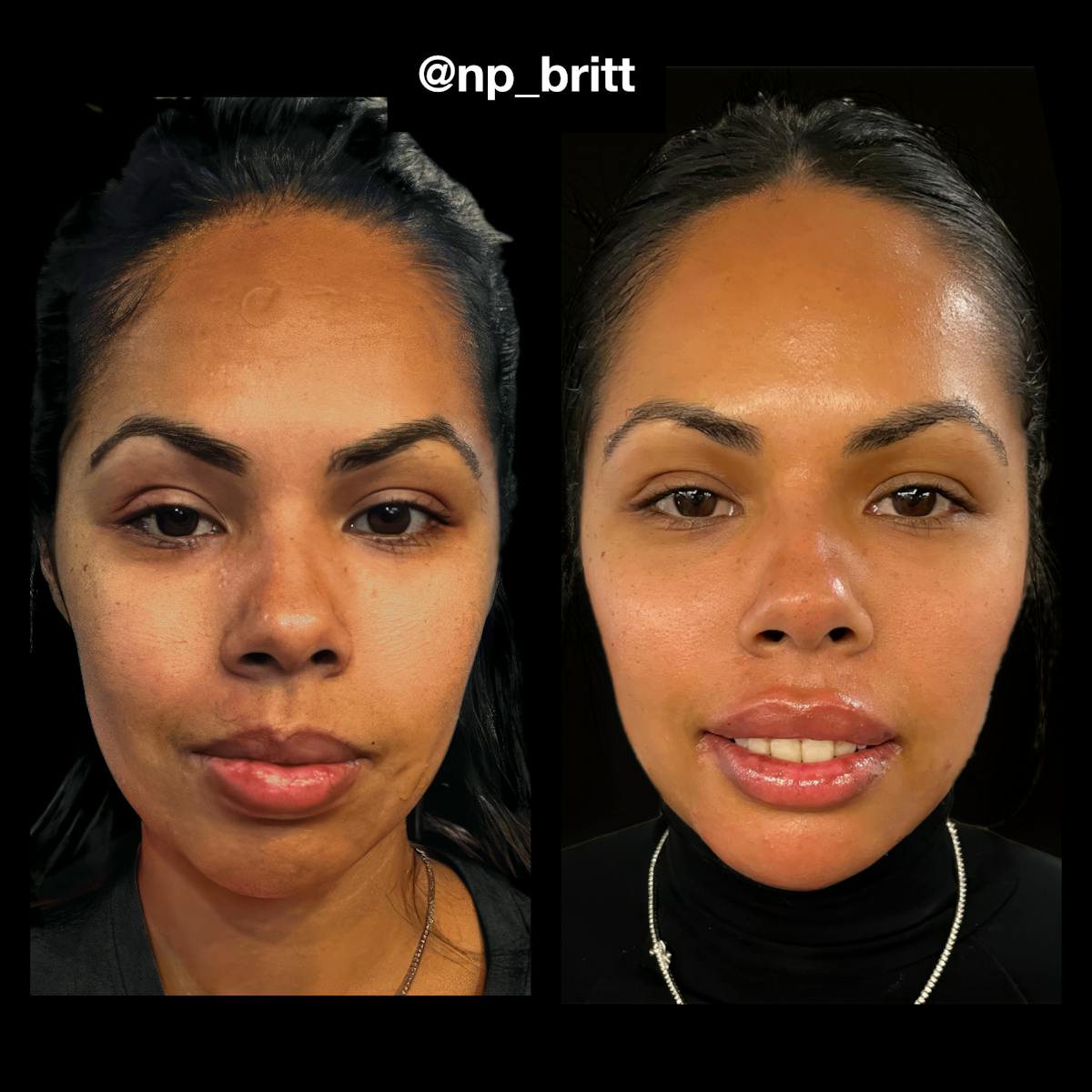Fillers Before & After Gallery - Patient 420845 - Image 1