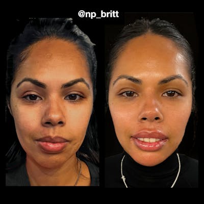 Fillers Before & After Gallery - Patient 420845 - Image 1