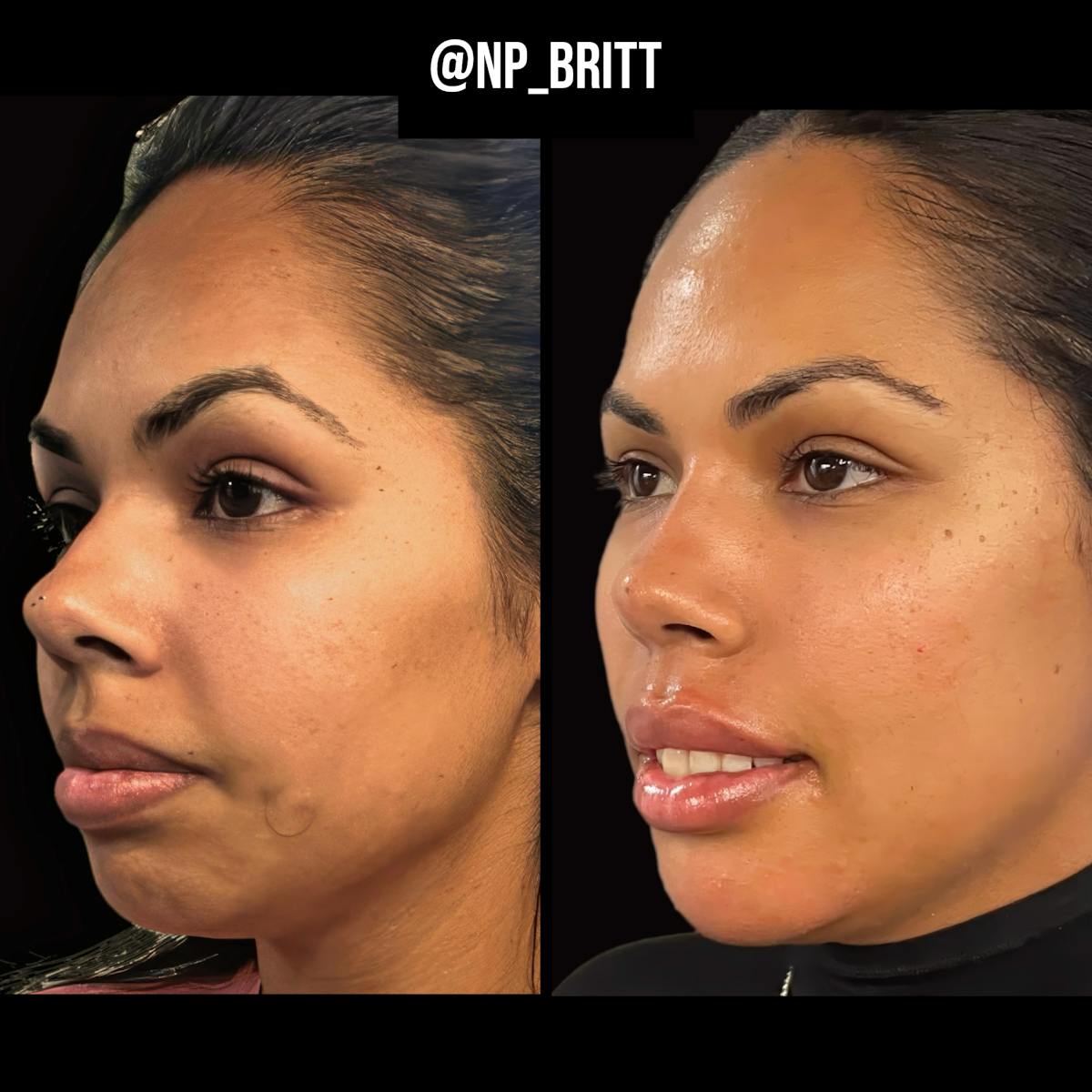 Fillers Before & After Gallery - Patient 420845 - Image 2