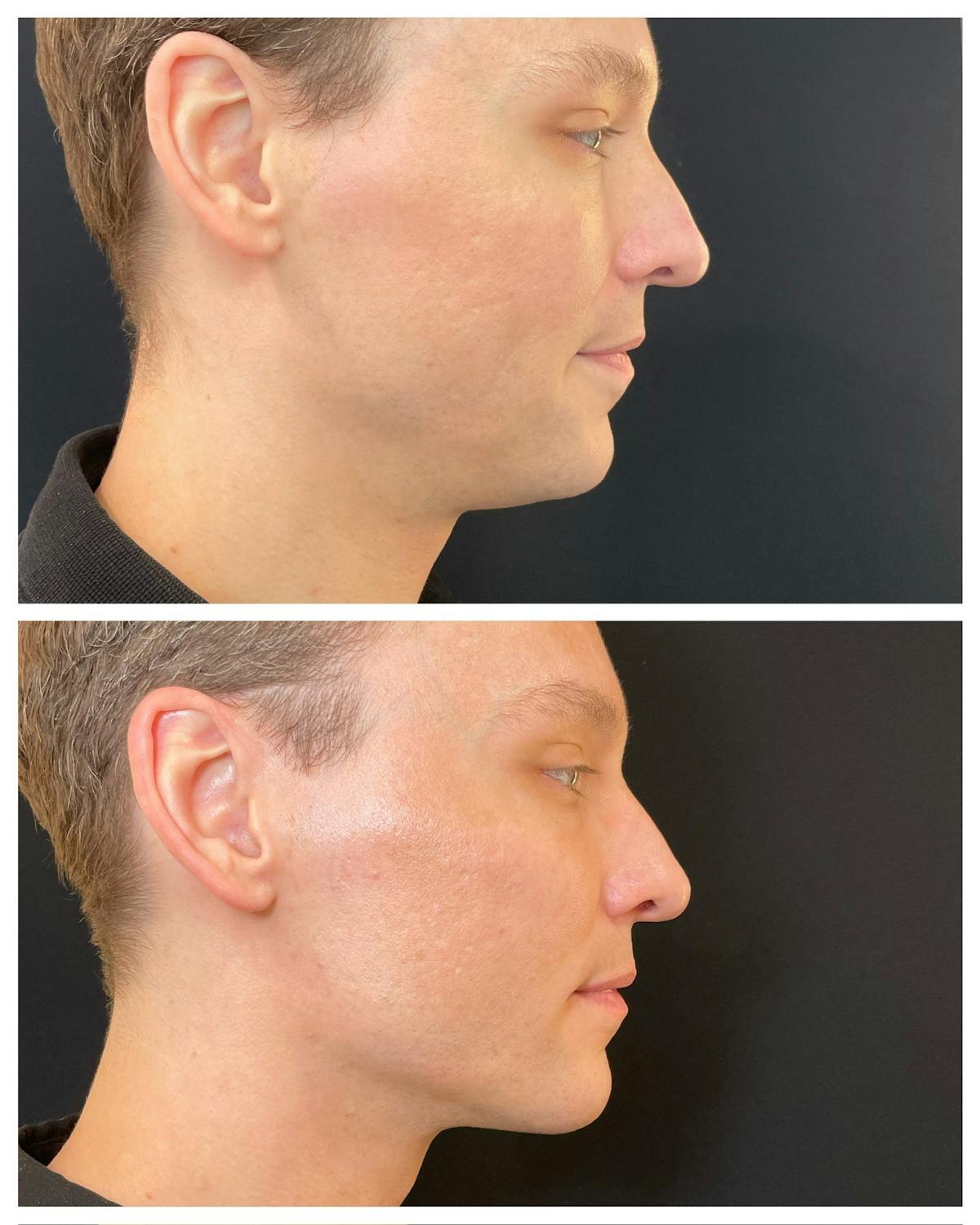 Fillers Before & After Gallery - Patient 958330 - Image 3