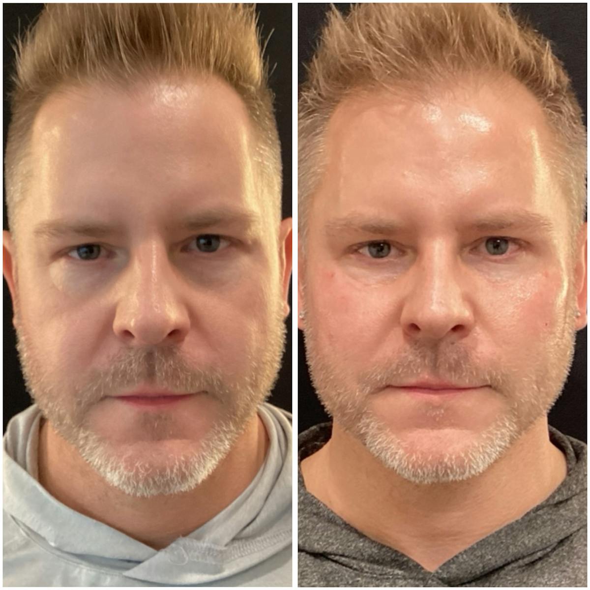 Fillers Before & After Gallery - Patient 175089 - Image 1