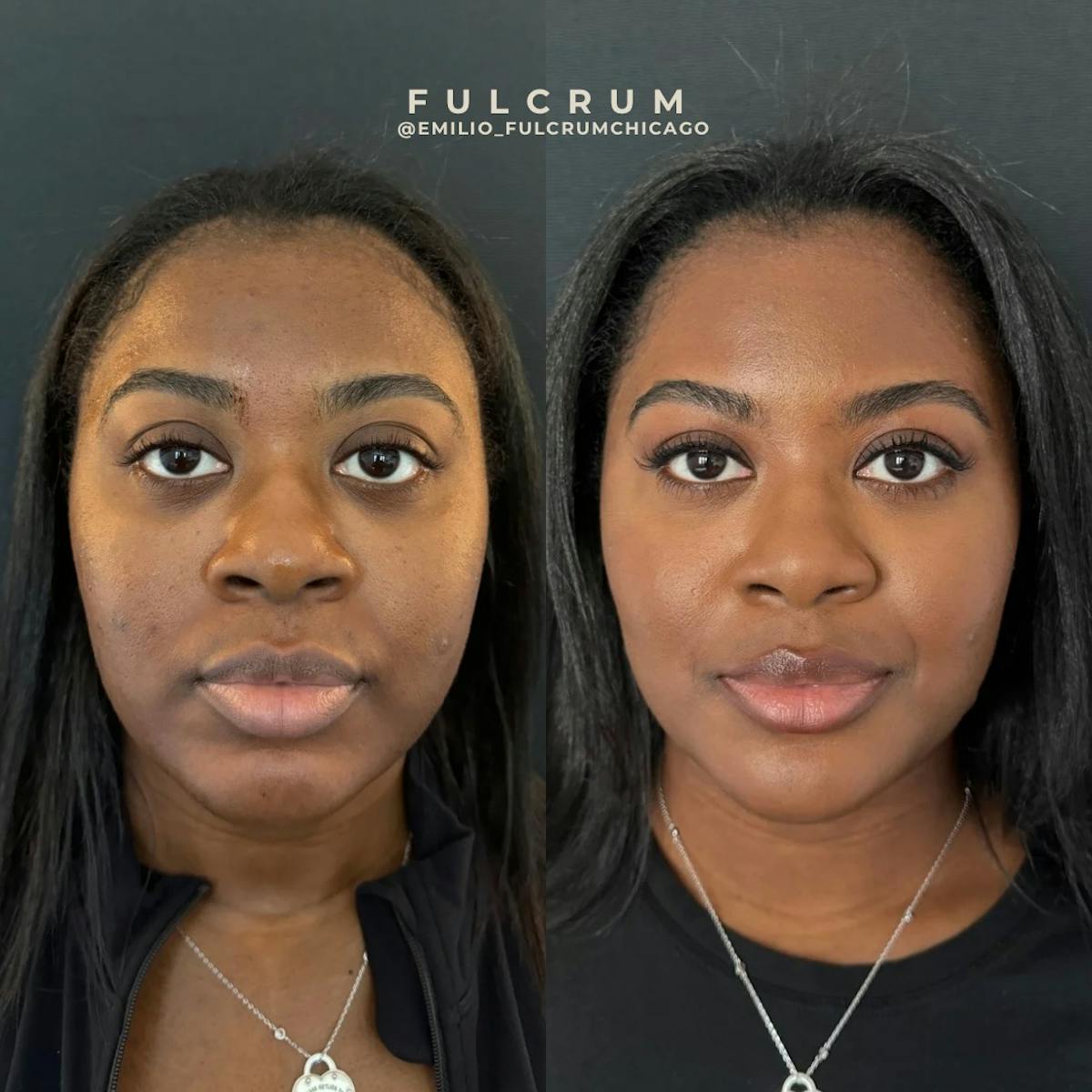 Fillers Before & After Gallery - Patient 180983 - Image 1