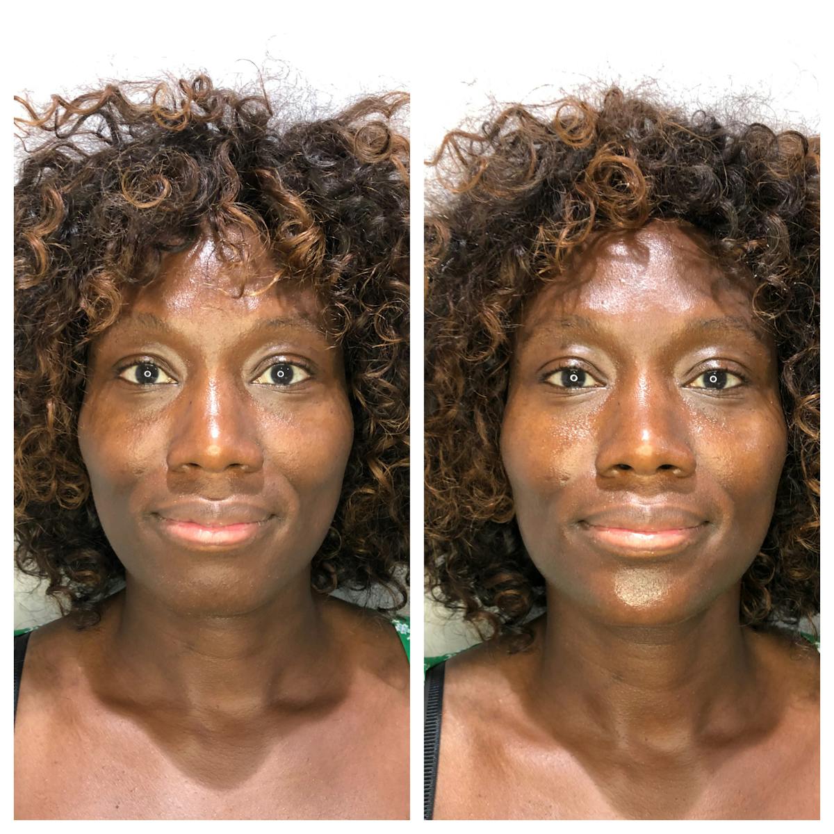 Fillers Before & After Gallery - Patient 164766 - Image 1