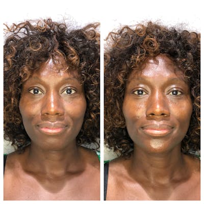 Fillers Before & After Gallery - Patient 164766 - Image 1