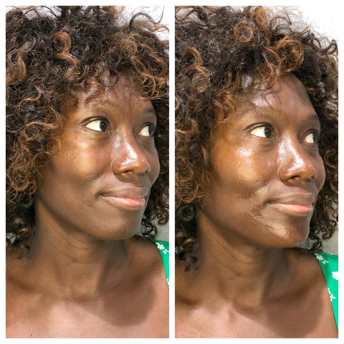 Fillers Before & After Gallery - Patient 164766 - Image 2