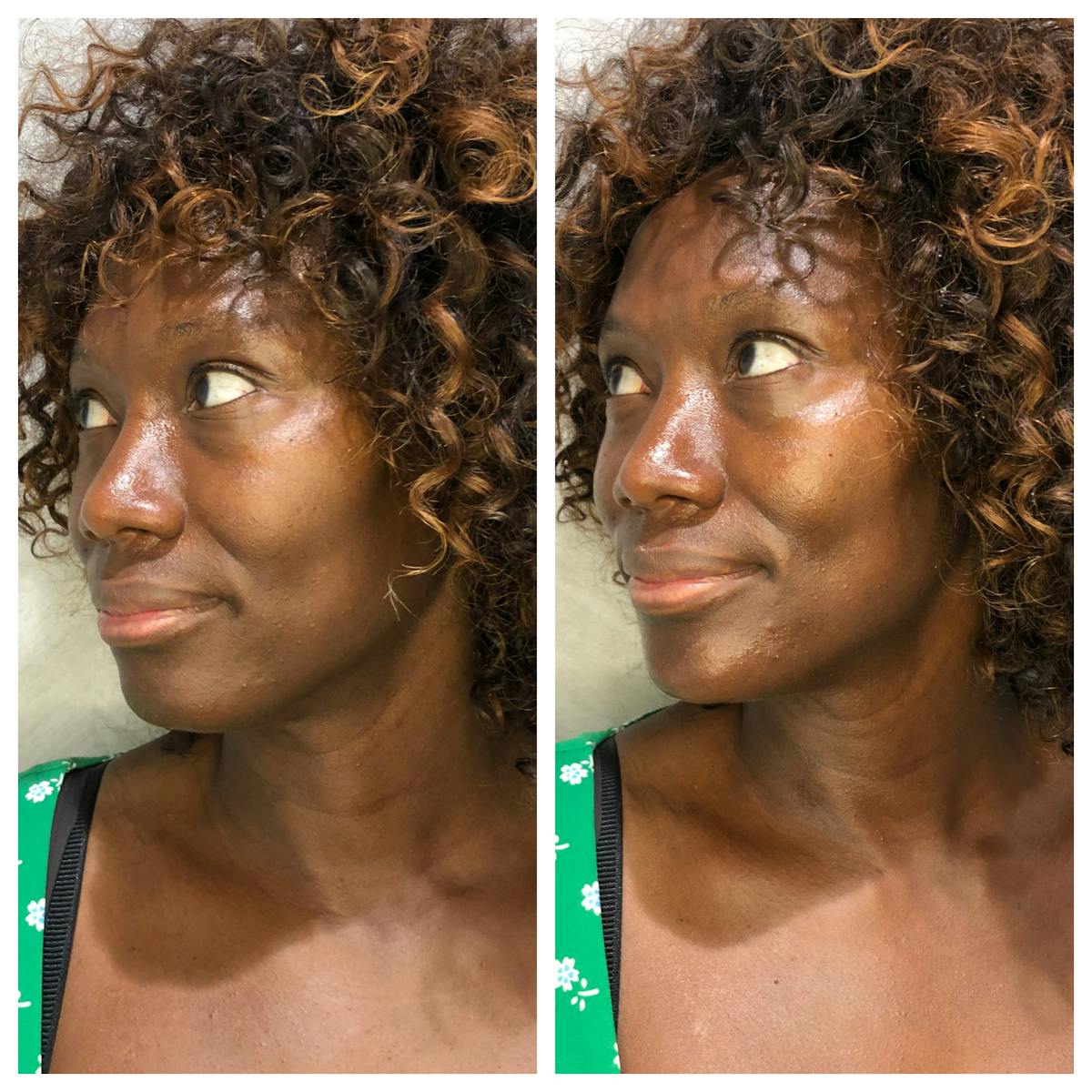 Fillers Before & After Gallery - Patient 164766 - Image 3