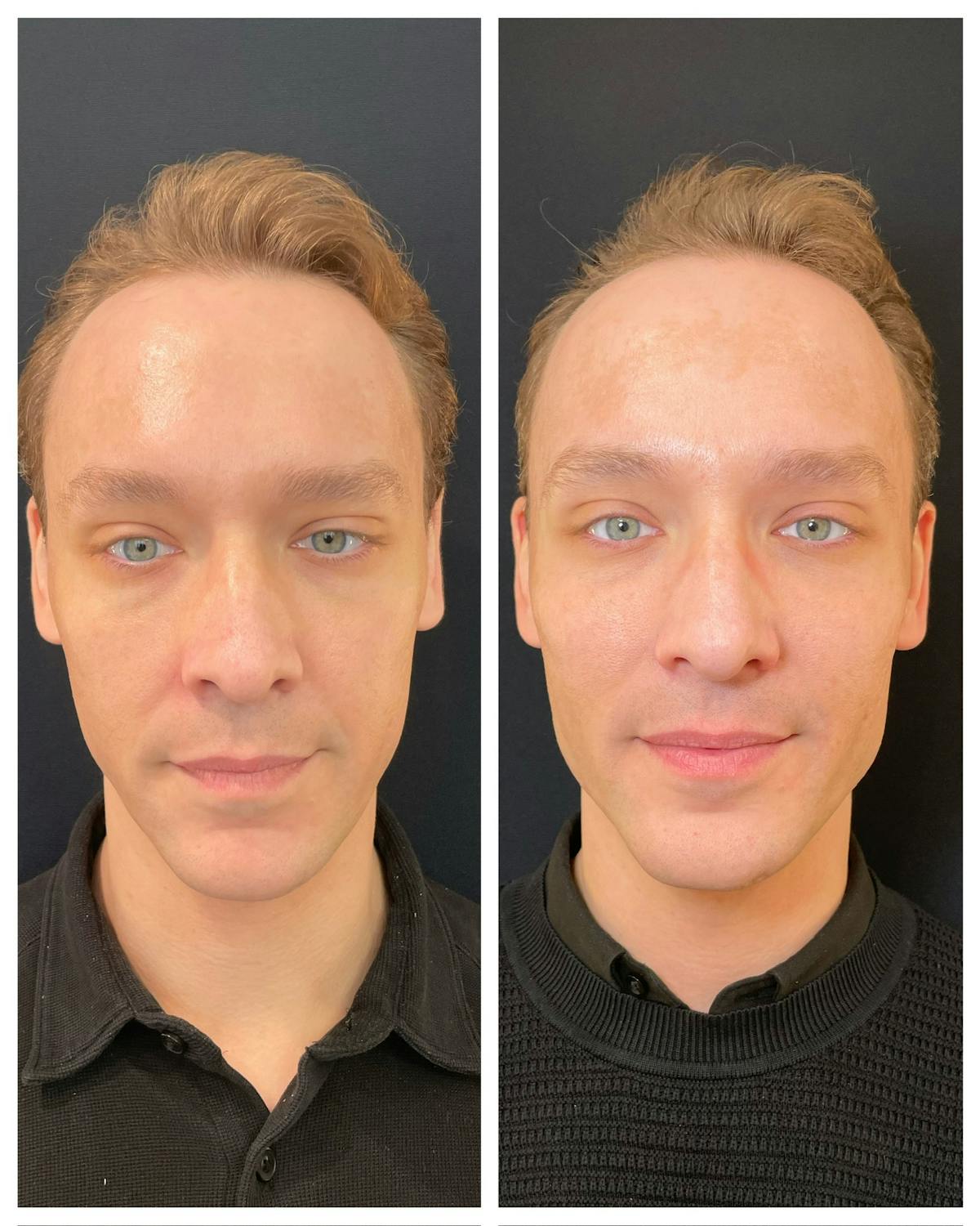 Fillers Before & After Gallery - Patient 315805 - Image 1
