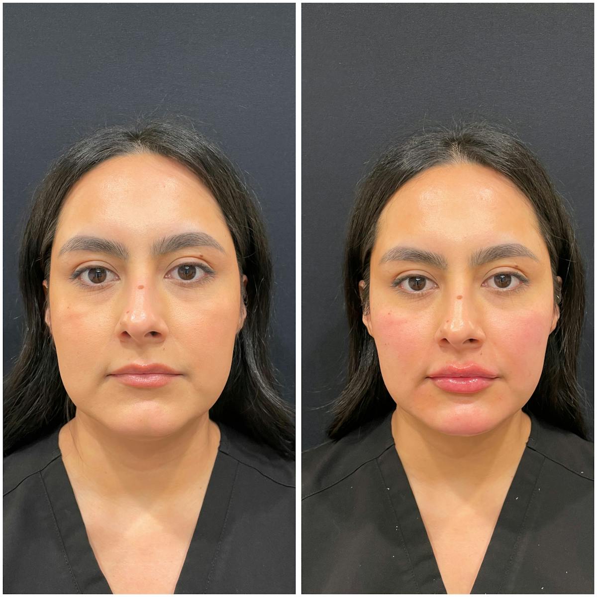 Fillers Before & After Gallery - Patient 389268 - Image 1