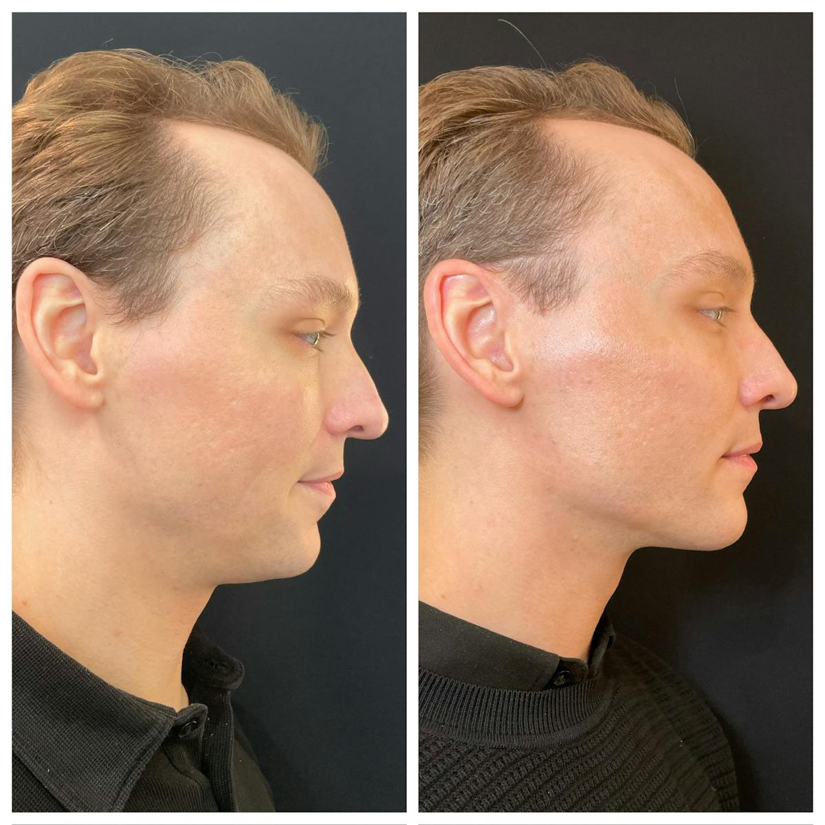 Fillers Before & After Gallery - Patient 315805 - Image 2