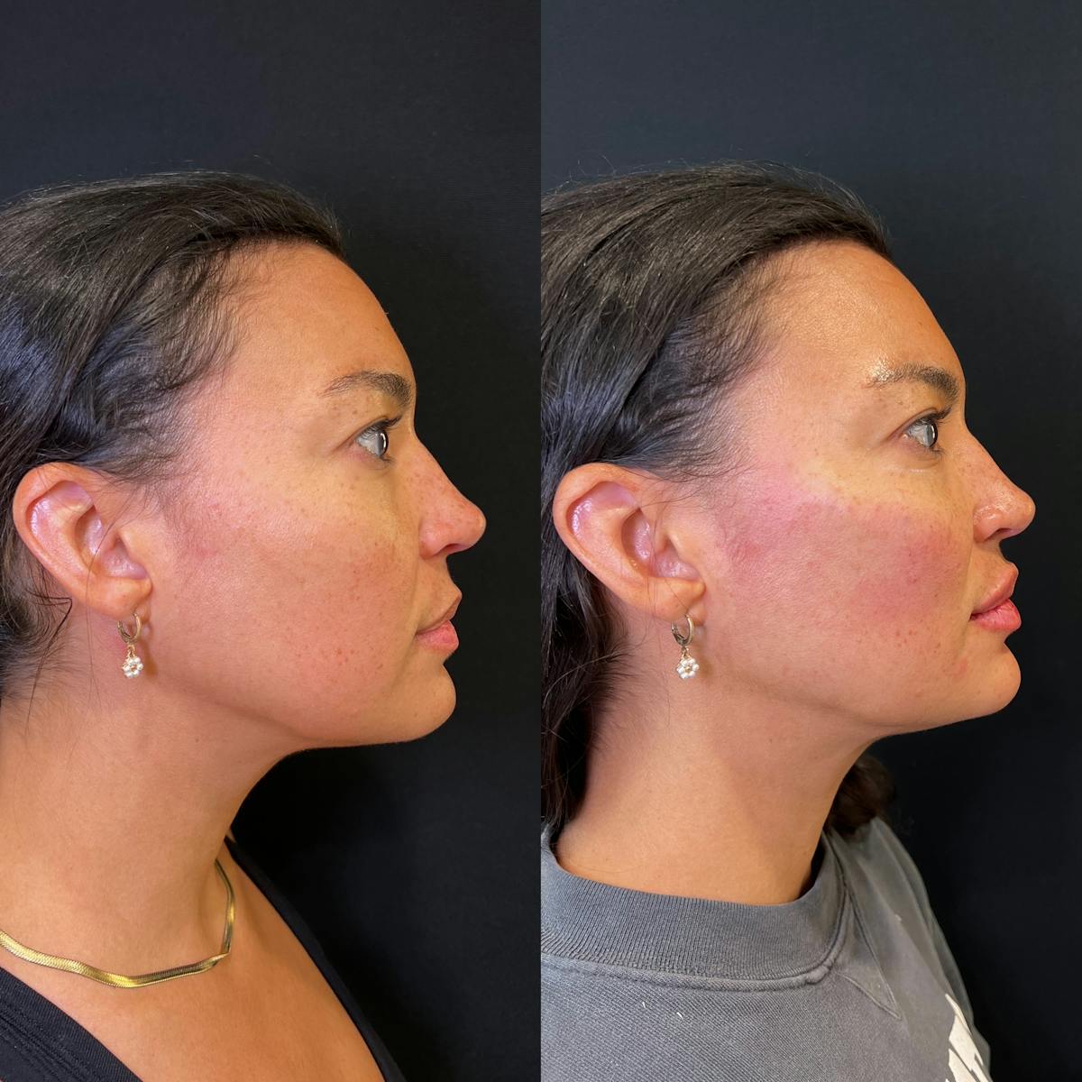 Fillers Before & After Gallery - Patient 217212 - Image 2