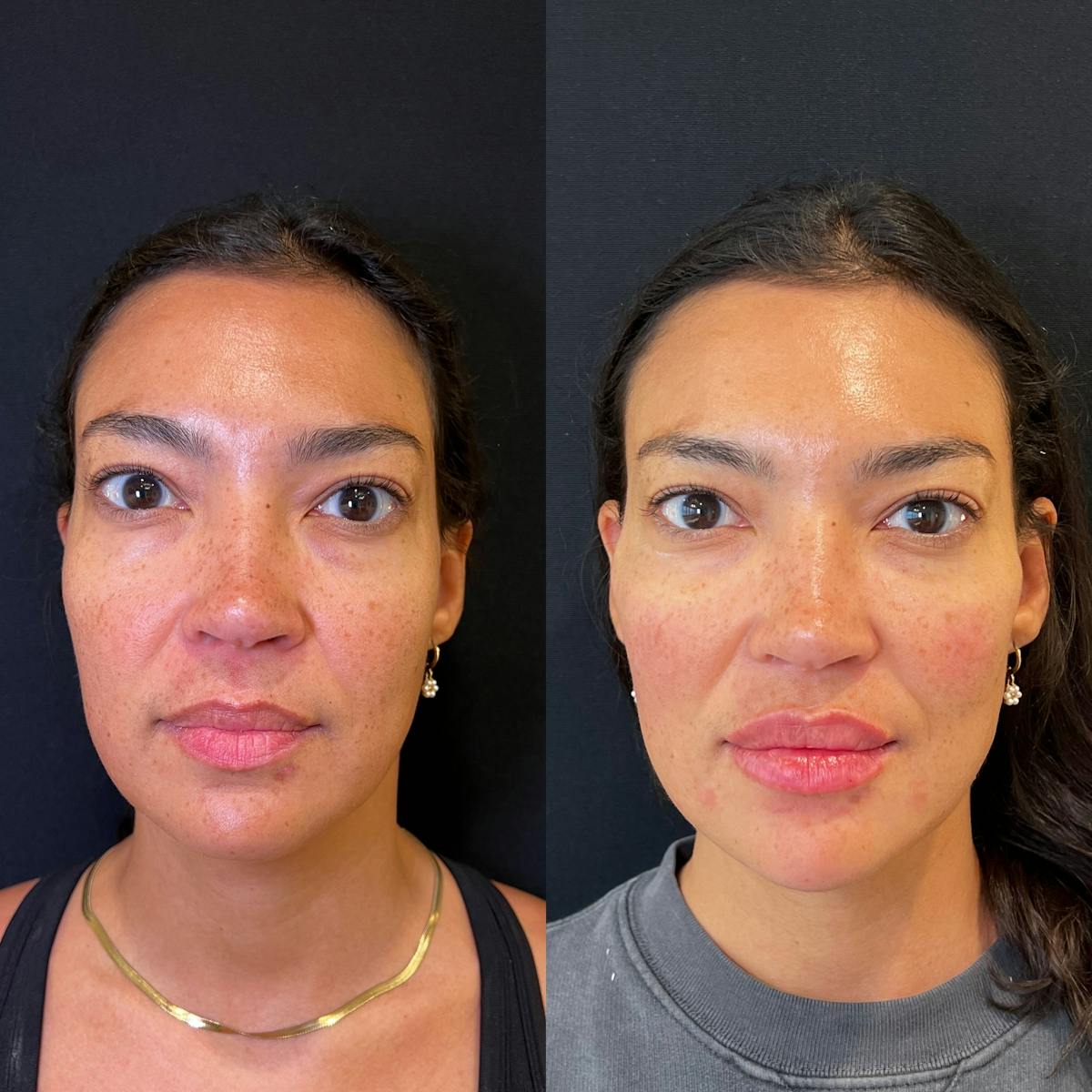 Fillers Before & After Gallery - Patient 217212 - Image 1