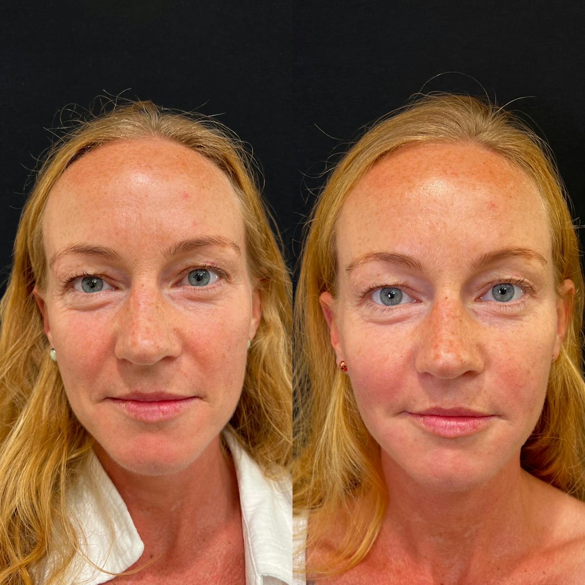 Fillers Before & After Gallery - Patient 121201 - Image 1