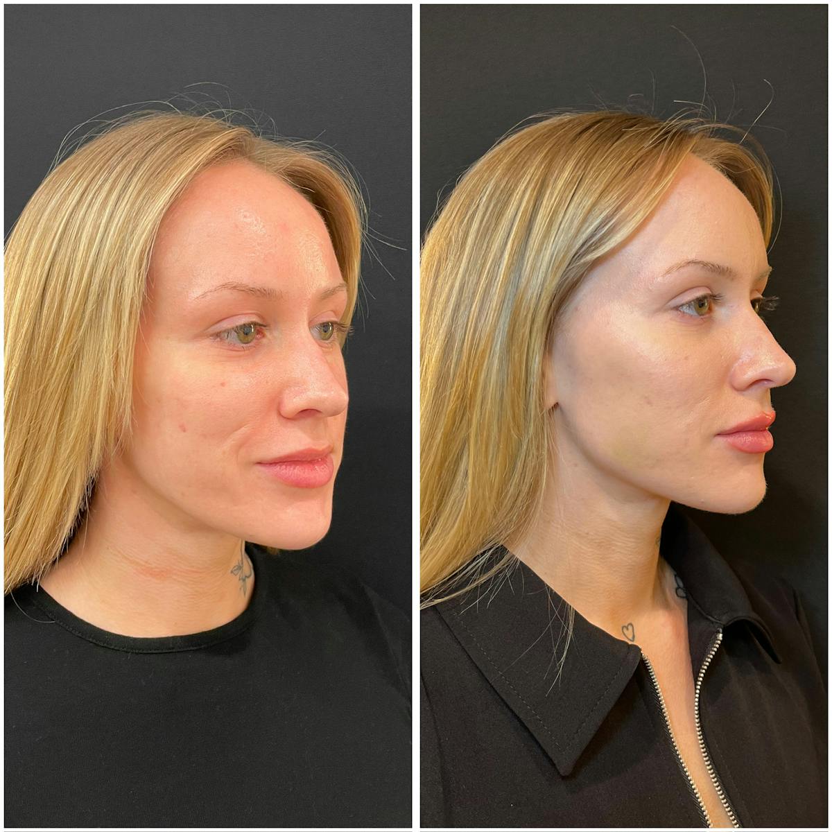 Fillers Before & After Gallery - Patient 424203 - Image 1
