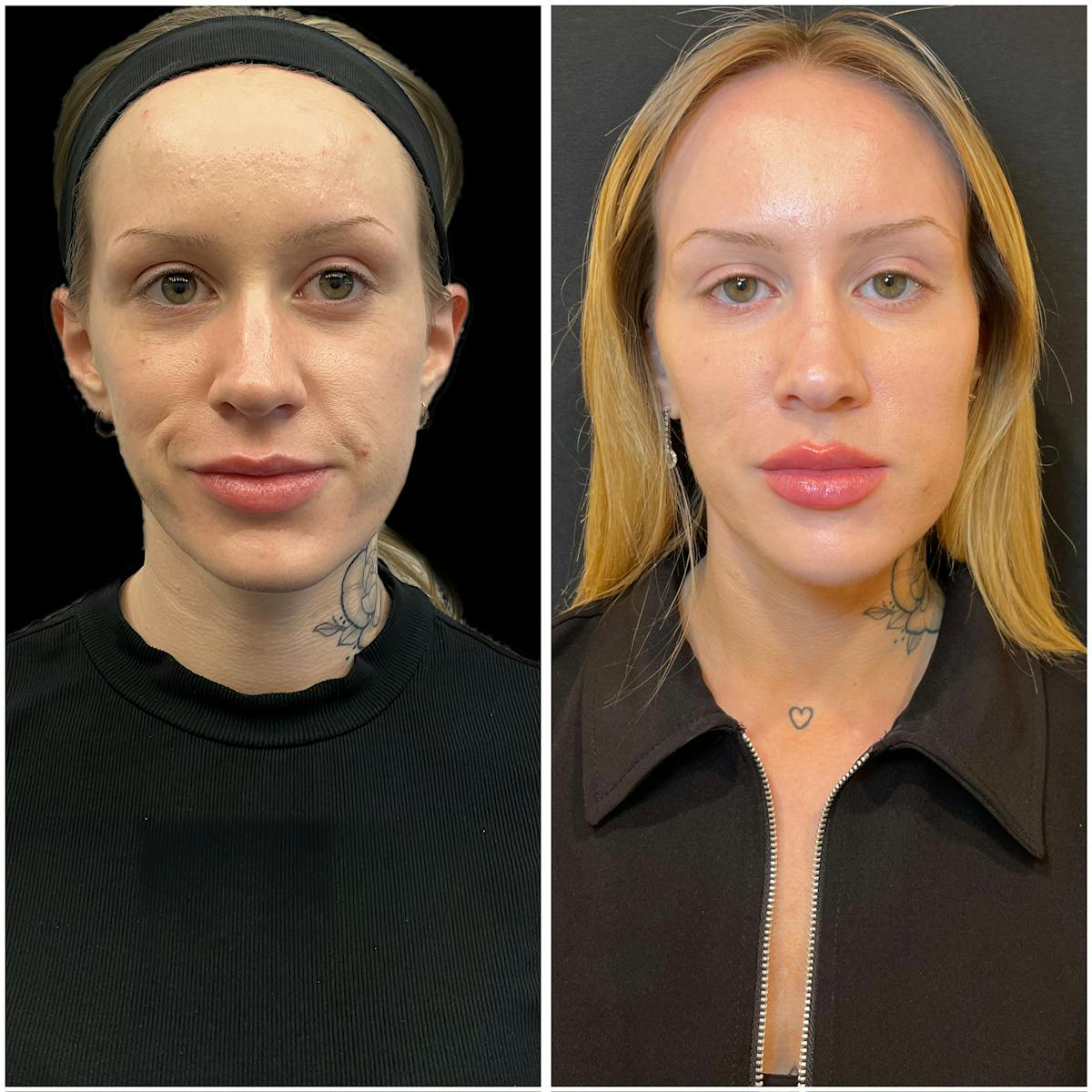 Fillers Before & After Gallery - Patient 424203 - Image 2