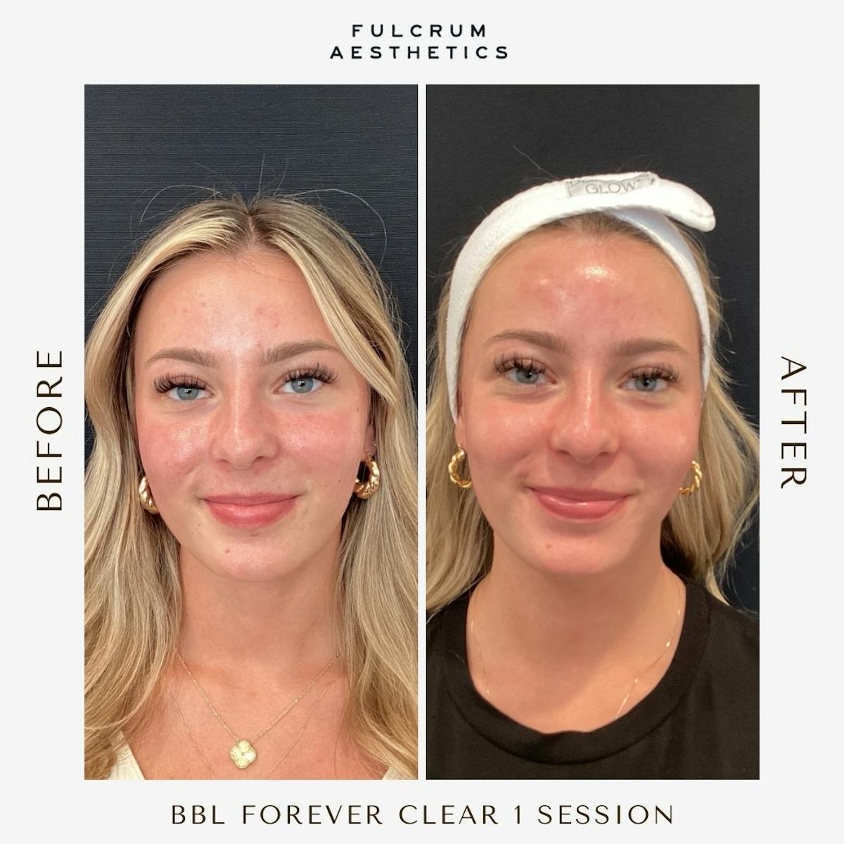 Lasers Before & After Gallery - Patient 311848 - Image 1