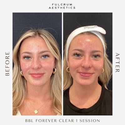 Lasers Before & After Gallery - Patient 311848 - Image 1