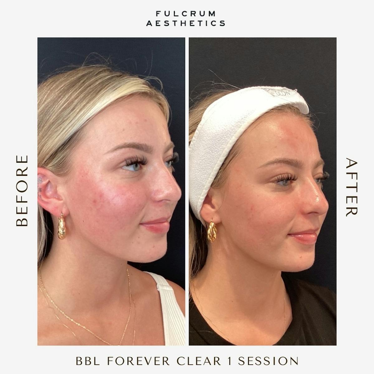 Lasers Before & After Gallery - Patient 311848 - Image 2
