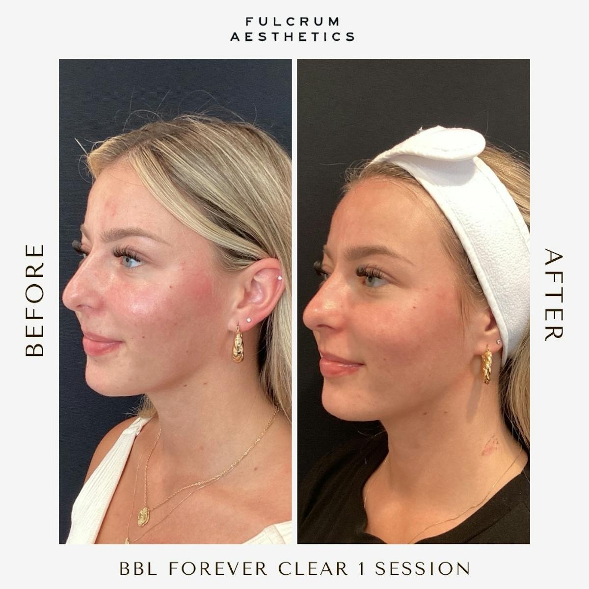 Lasers Before & After Gallery - Patient 311848 - Image 3