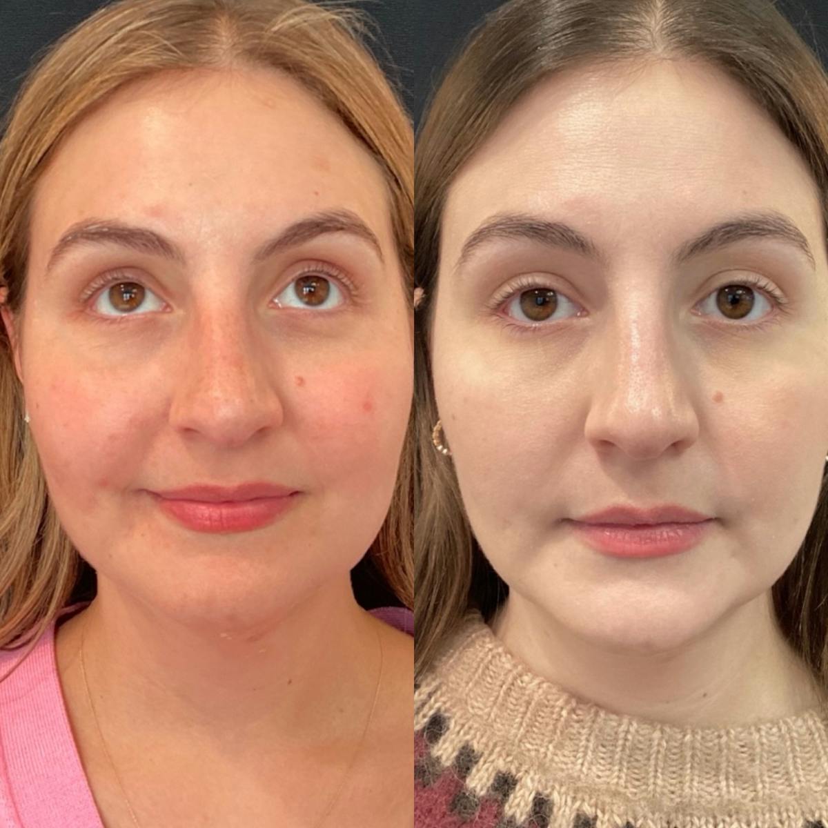 Lasers Before & After Gallery - Patient 338974 - Image 1