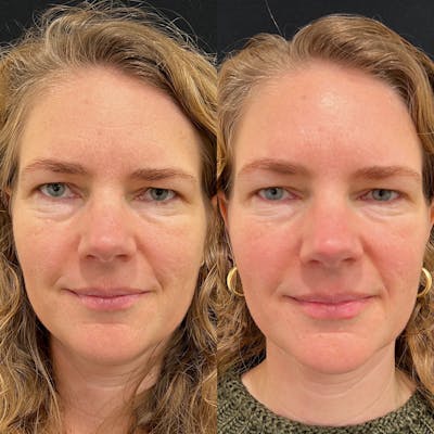Lasers Before & After Gallery - Patient 286815 - Image 1