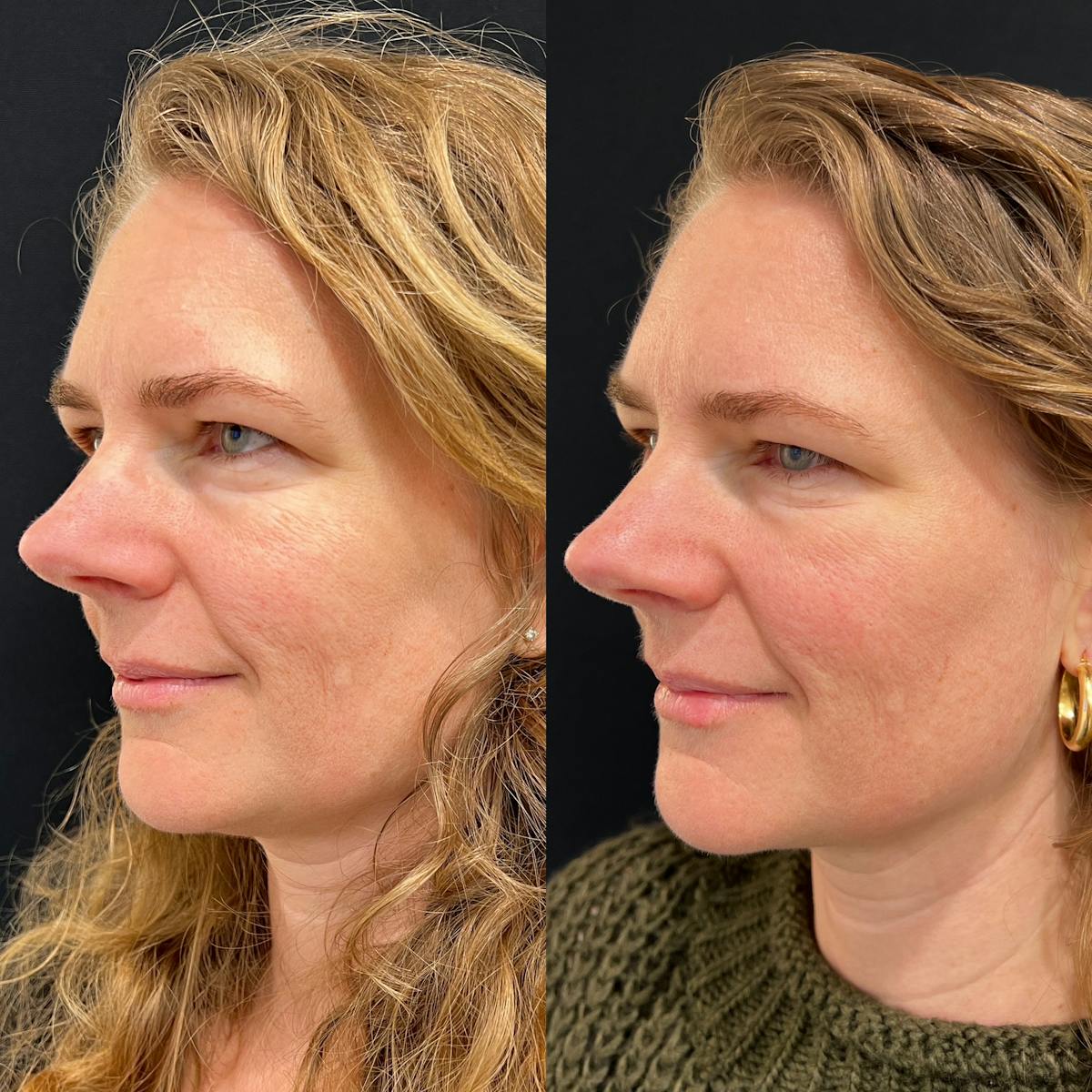 Lasers Before & After Gallery - Patient 286815 - Image 3