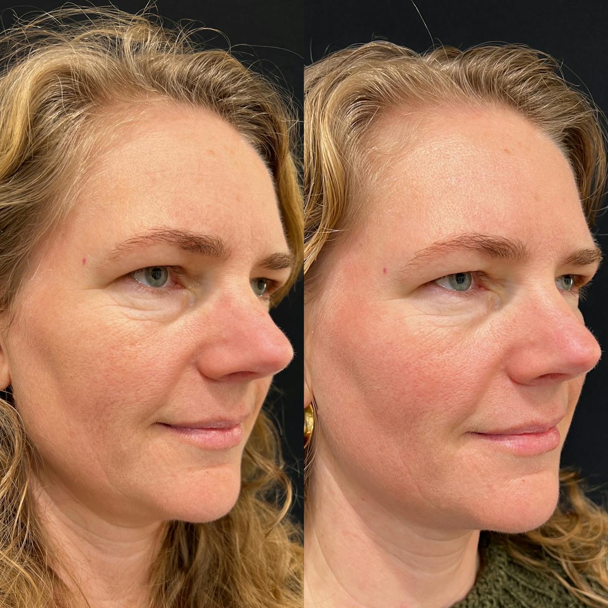 Lasers Before & After Gallery - Patient 286815 - Image 2