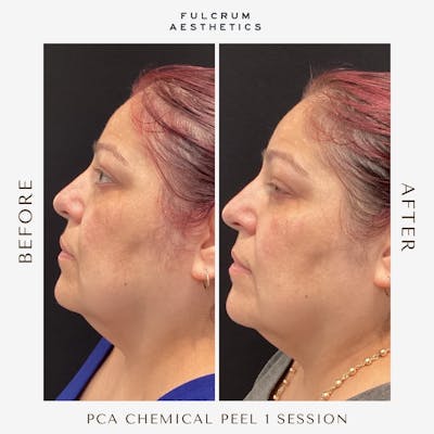 Chemical Peels Before & After Gallery - Patient 264062 - Image 1