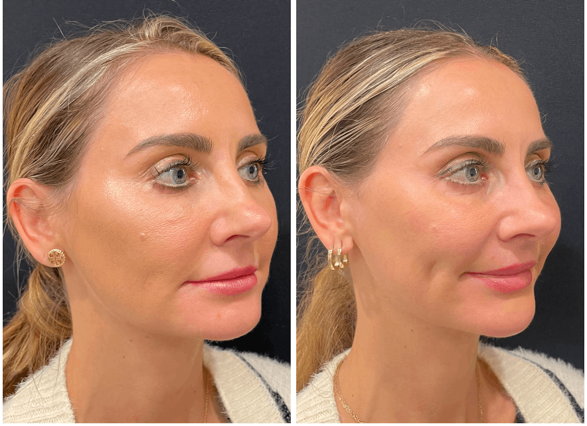 Lasers Before & After Gallery - Patient 202038 - Image 1