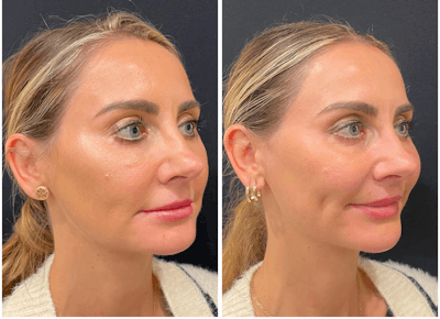 Lasers Before & After Gallery - Patient 202038 - Image 1