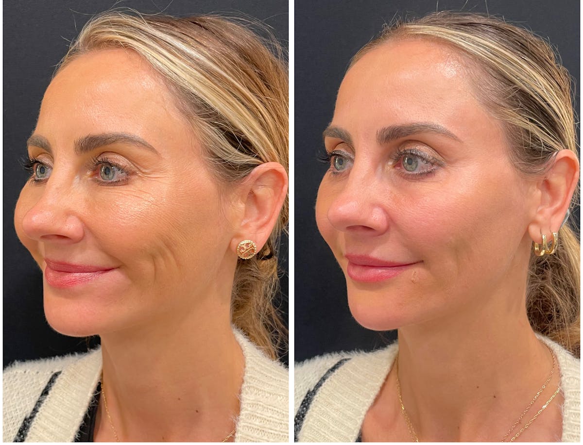 Lasers Before & After Gallery - Patient 202038 - Image 3