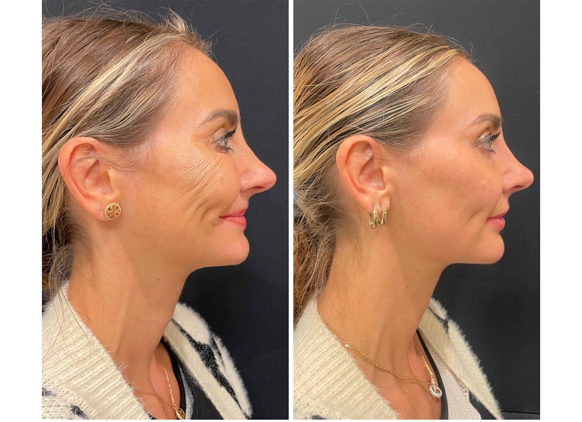 Lasers Before & After Gallery - Patient 202038 - Image 2