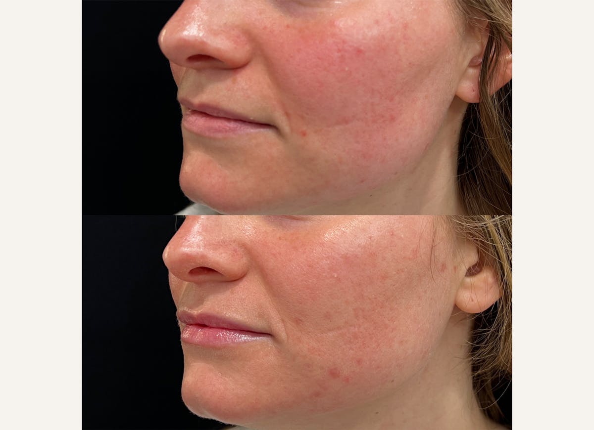 Fillers Before & After Gallery - Patient 155018 - Image 1