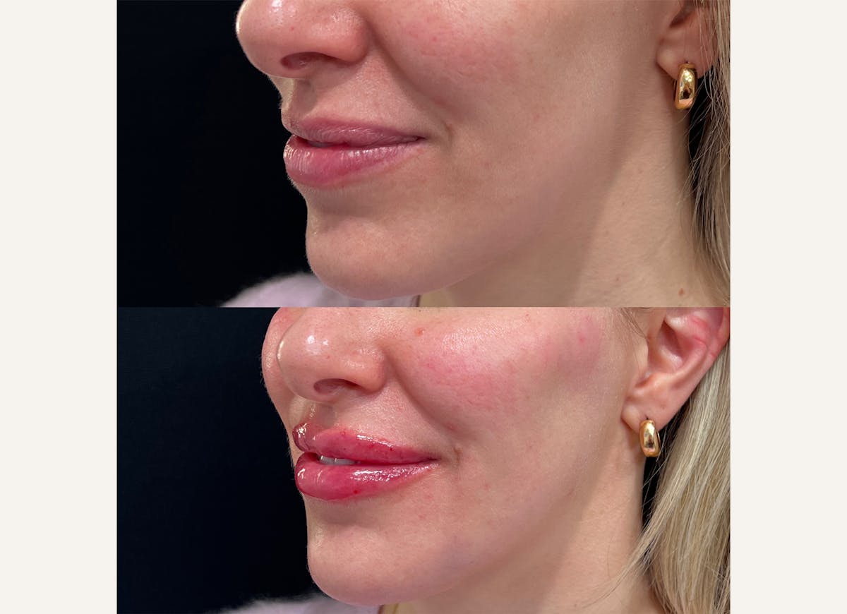 Fillers Before & After Gallery - Patient 332803 - Image 1