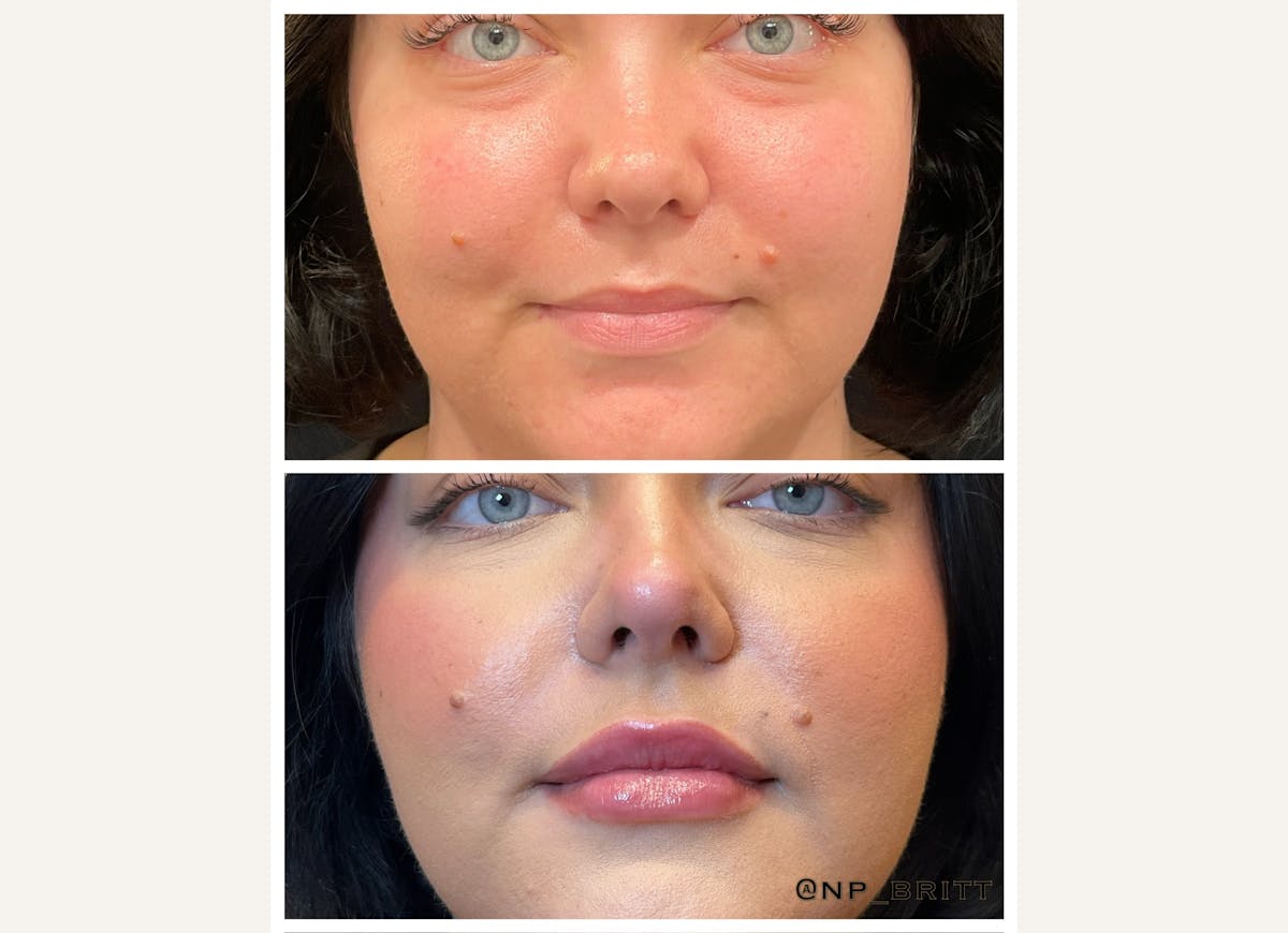 Fillers Before & After Gallery - Patient 299927 - Image 1