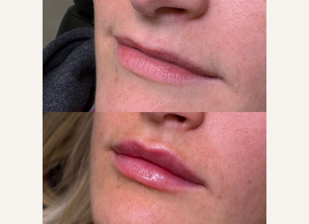 Fillers Before & After Gallery - Patient 445425 - Image 1