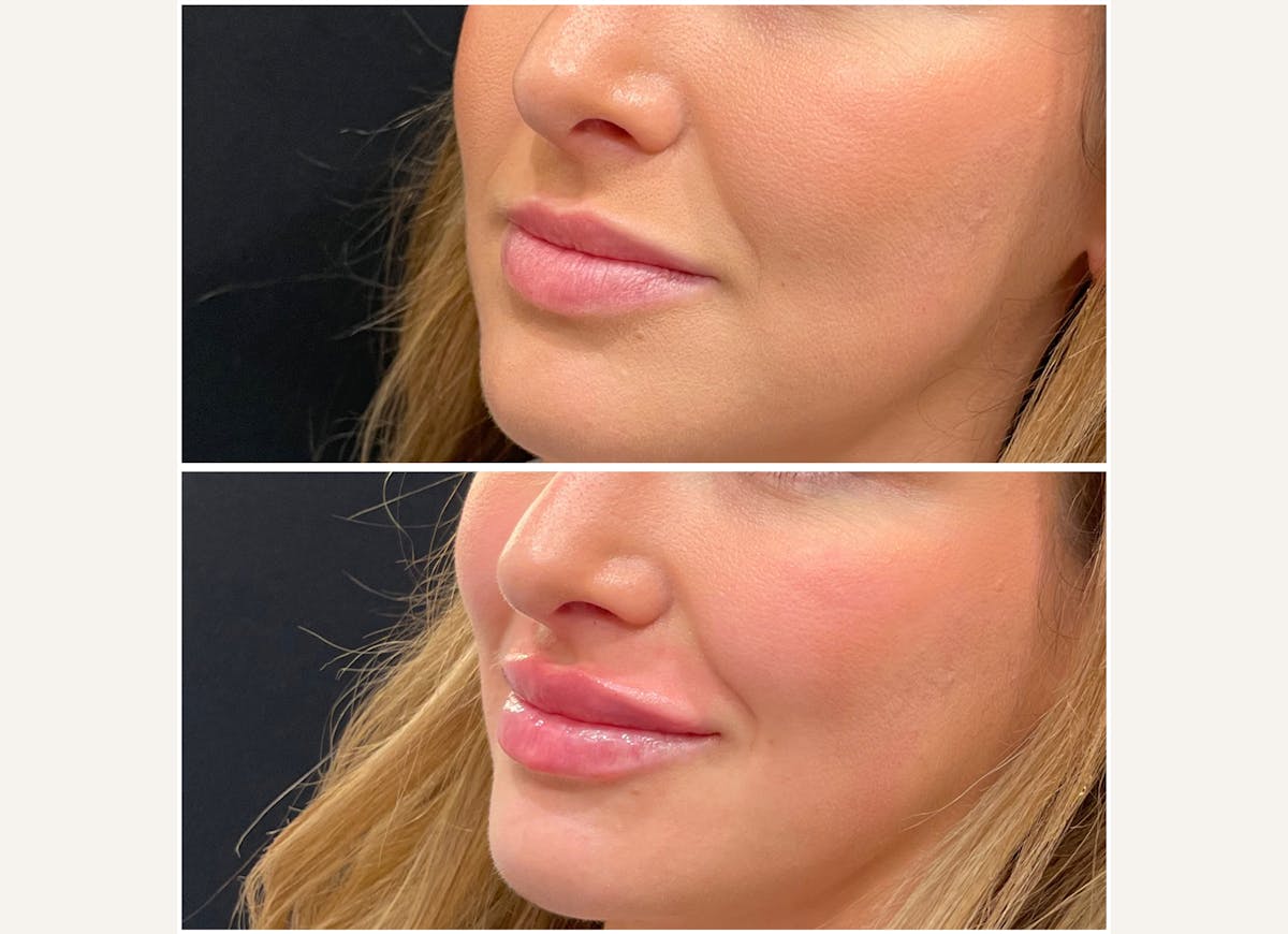 Fillers Before & After Gallery - Patient 226589 - Image 1