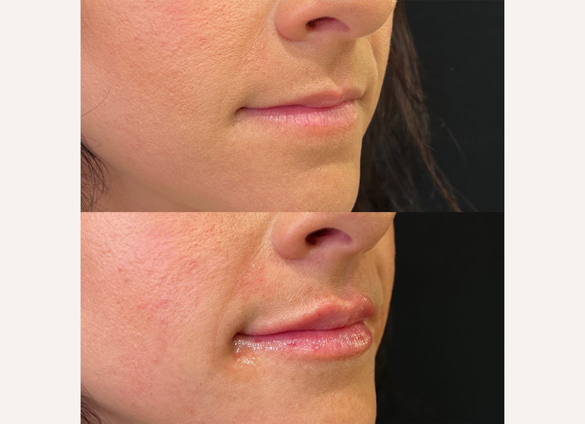 Fillers Before & After Gallery - Patient 393518 - Image 1