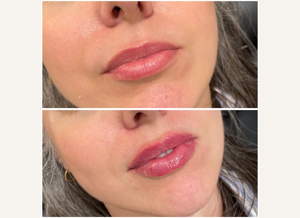 Fillers Before & After Gallery - Patient 158533 - Image 1