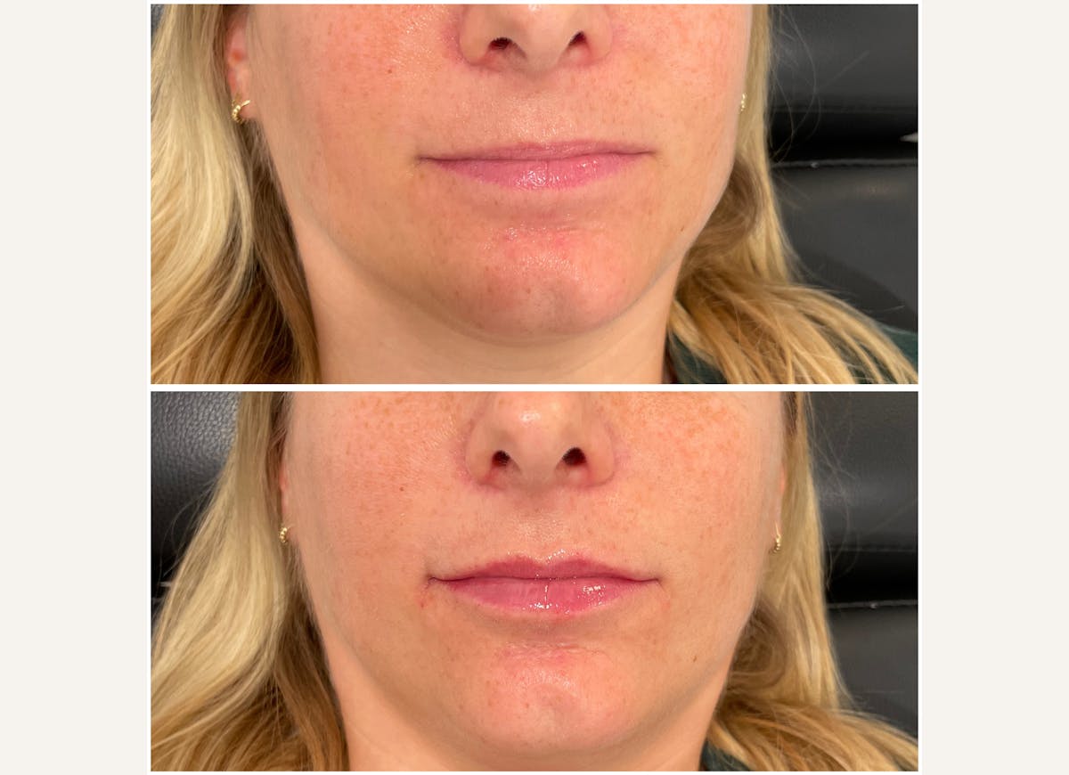 Fillers Before & After Gallery - Patient 111819 - Image 1