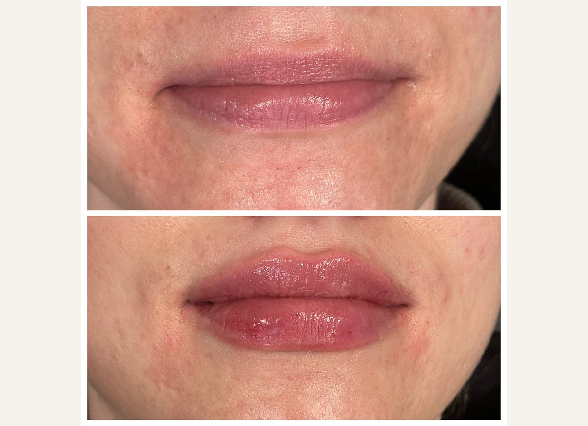 Fillers Before & After Gallery - Patient 253237 - Image 1