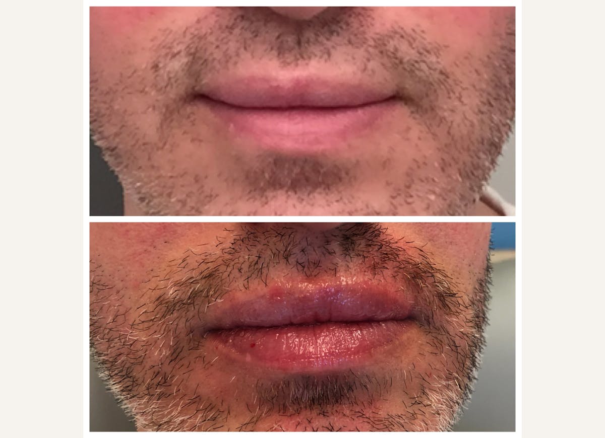 Fillers Before & After Gallery - Patient 408076 - Image 1