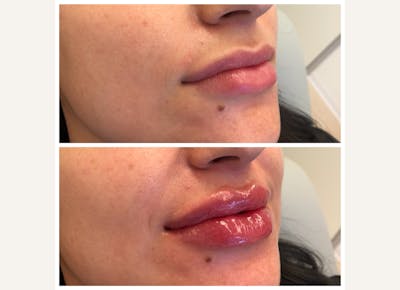 Fillers Before & After Gallery - Patient 103118 - Image 1