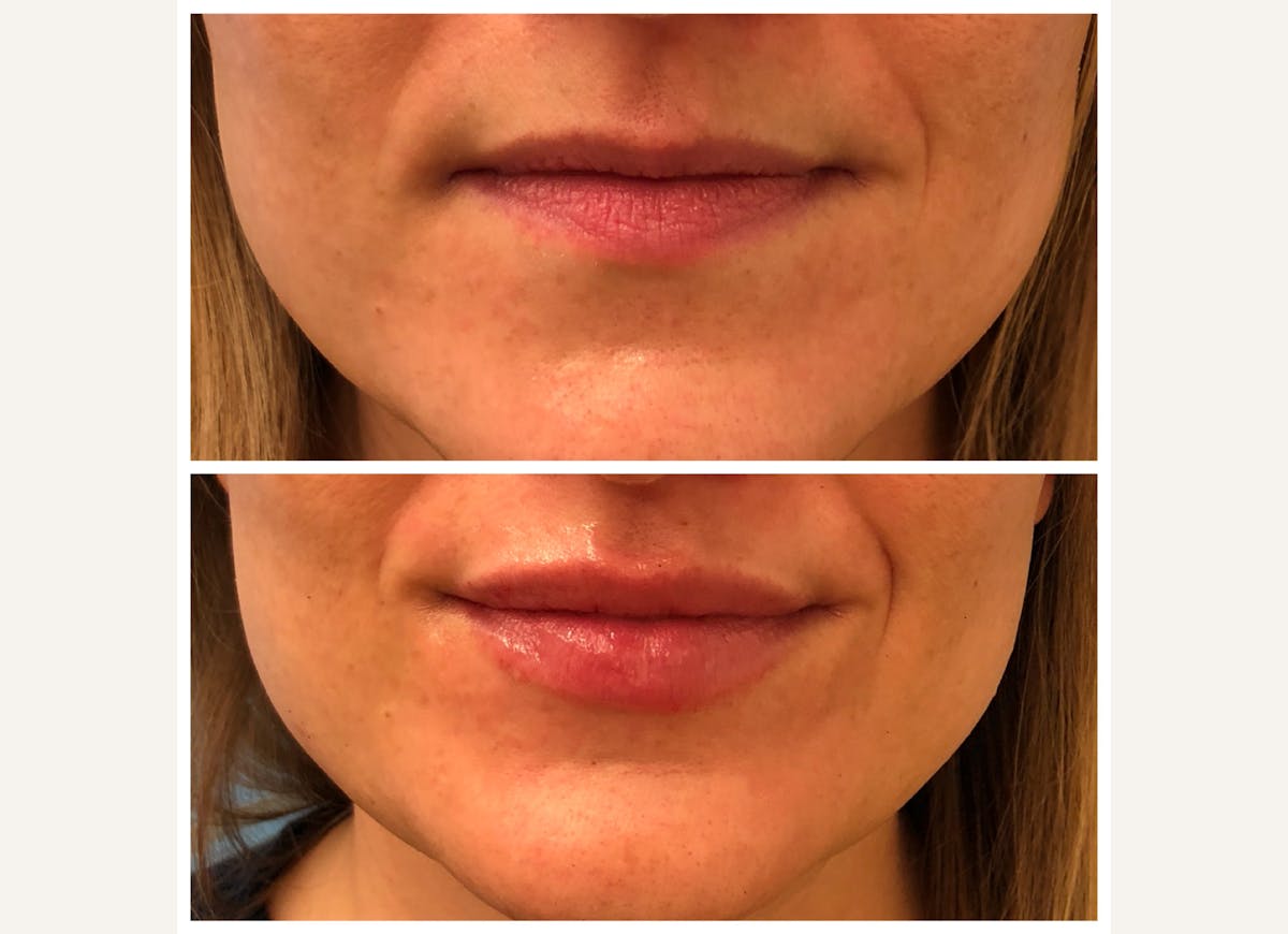 Fillers Before & After Gallery - Patient 315559 - Image 1