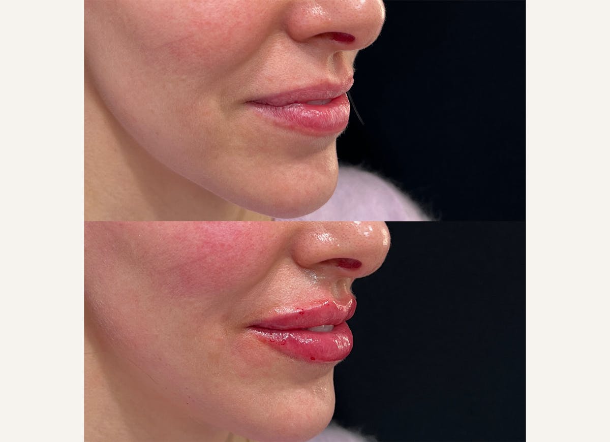 Fillers Before & After Gallery - Patient 121027 - Image 1