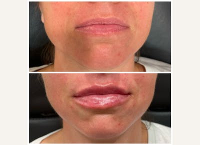 Fillers Before & After Gallery - Patient 983818 - Image 1