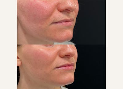 Fillers Before & After Gallery - Patient 110072 - Image 1