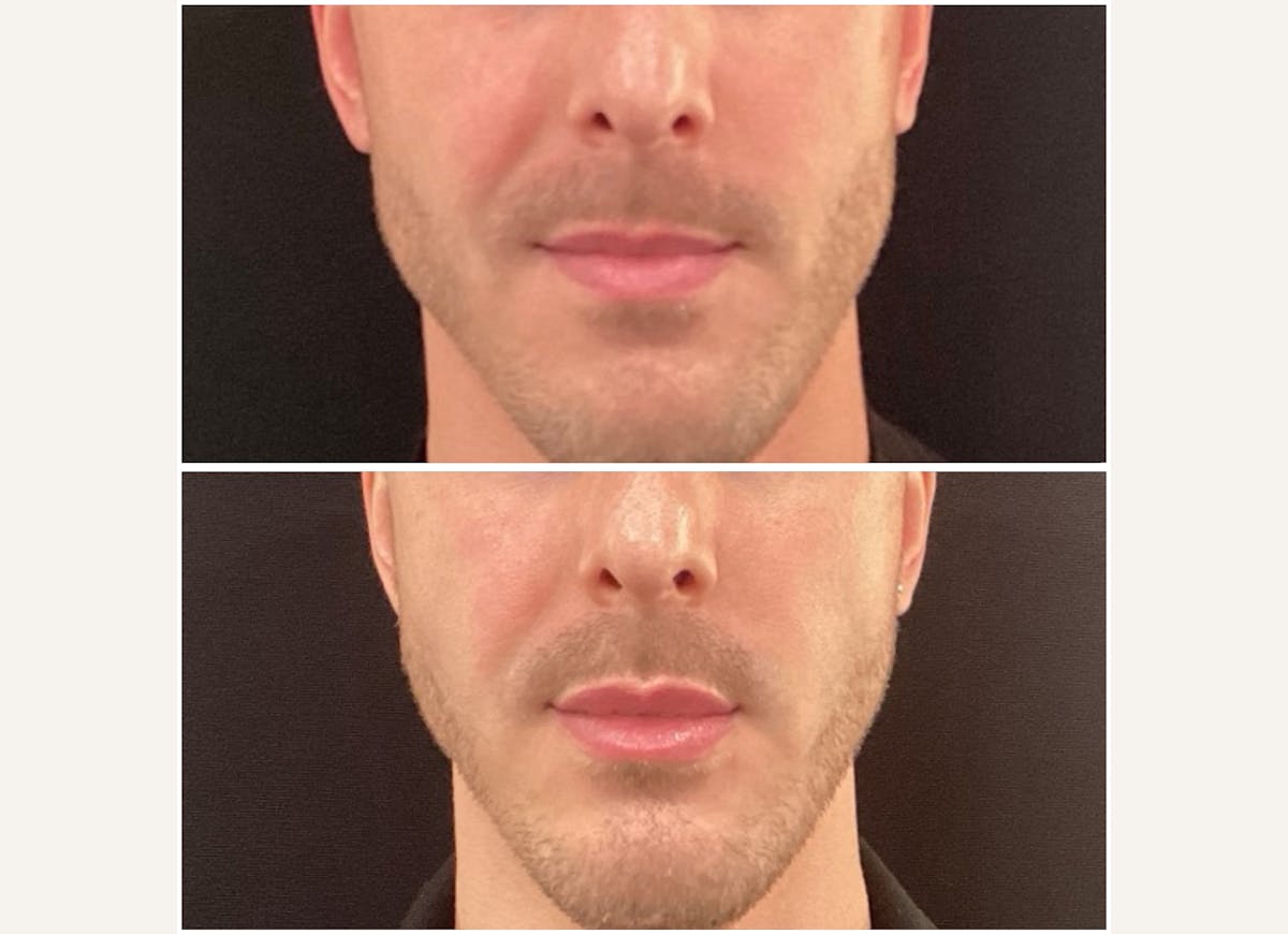 Fillers Before & After Gallery - Patient 162092 - Image 1