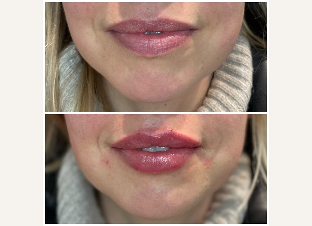 Fillers Before & After Gallery - Patient 145858 - Image 1