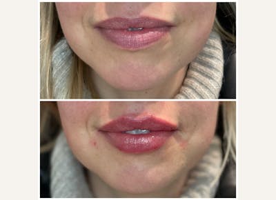 Fillers Before & After Gallery - Patient 145858 - Image 1