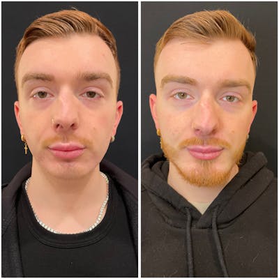 Fillers Before & After Gallery - Patient 195375 - Image 1